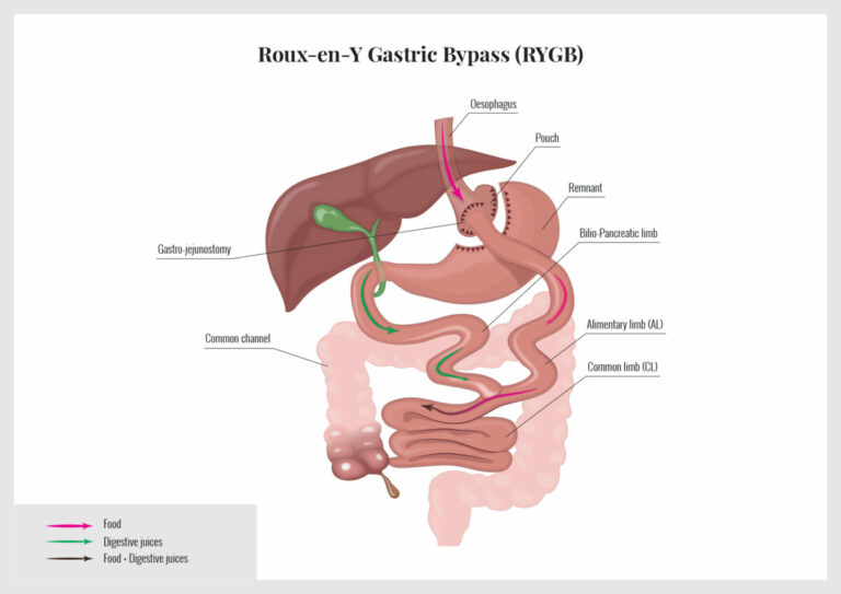 Gastric bypass – Roux-en-Y