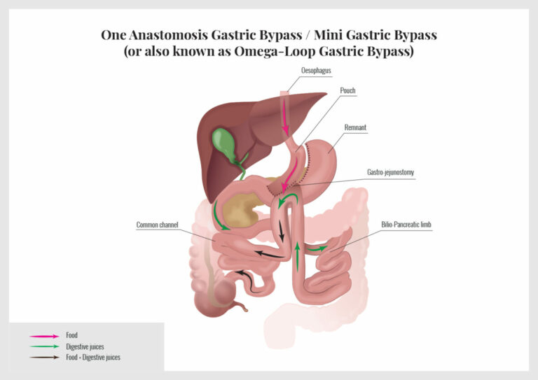 Gastric bypass – OAGB or Mini Bypass Gastric bypass – OAGB