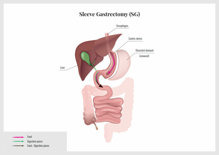 Sleeve_Gastrectomy