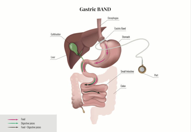 8_Adjustable_Gastric_BAND_(lap_band)